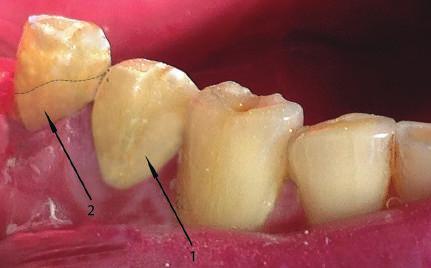 24 Originalni radovi Fig. 6. The restoration of tooth 4.5 by light-cured glass ionomers filling material Ionolux, VOCO (2) Slika 6. Popravka zuba 4.