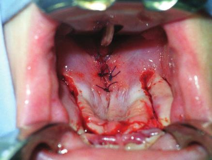 Fetalni alkoholni sindrom Klinička slika Najčešći sindrom udružen s rascepom usnice i nepca 80% imaju rascep usnice i nepca Mikrognatija Glosoptoza Poremećaj vezivnog tkiva Hipoplazija, mikrognatija,