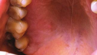 Najčešće lokalizacije su unutrašnja strana usana, obraza i lateralna strana jezika, koji čine 71% svih fibroma u usnoj šupljini.