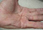 CASE 5: HAROLD S HAND A 64-year-old male presents to the office with worsening stiffness in the palm of his left hand.