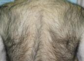 CASE 7: BARRY S BACK Barry presented with a history of excessive hair growing over his upper back. 1. What do you call such a condition? 1. Hirsutism. 2.