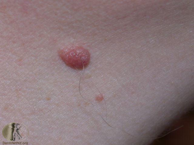 Benign nevus (Mole) If new or pearly