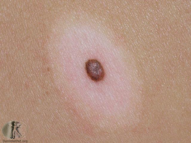 Halo nevus Can be benign However, marker for
