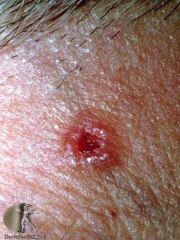 Basal cell carcinoma Pearly / Not
