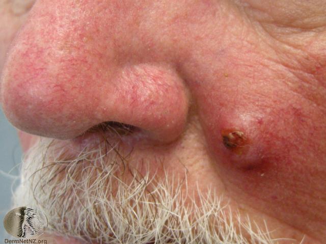 Squamous cell carcinoma Can also be Basal