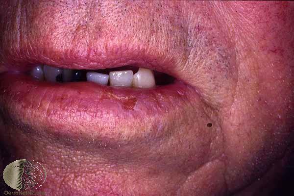 Squamous cell lip slight surface change KEY to catch