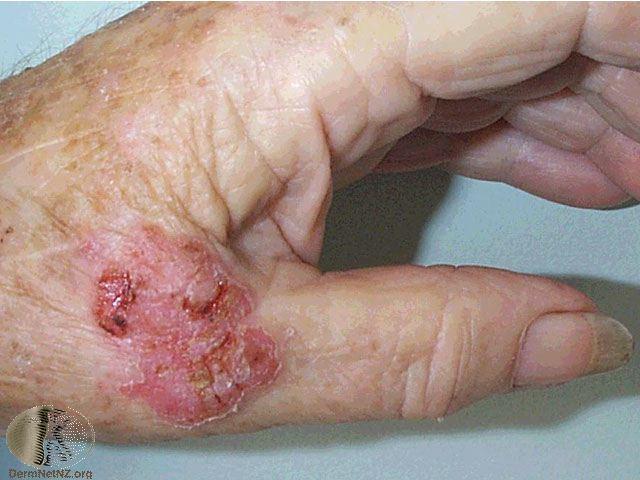 Early Squamous cell Looks like Eczema / Psoriasis /