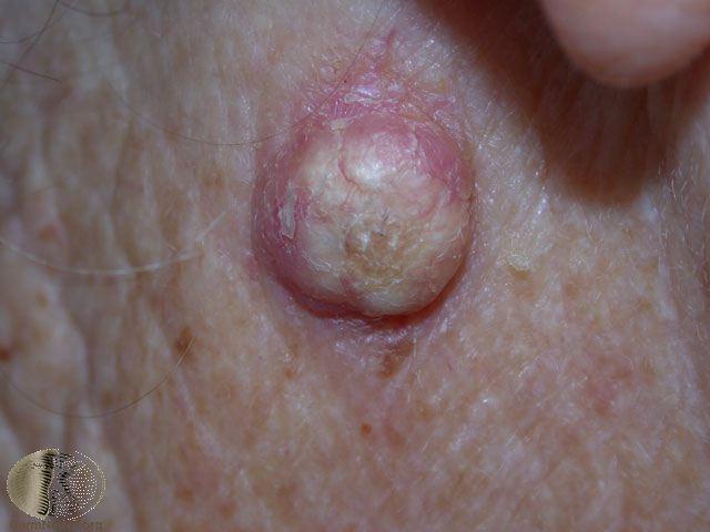 Keratoacanthoma version of Squamous cell carcinoma - can LOOK like a