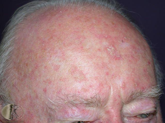 Actinic keratoses Pre cancers Treated with freezing or
