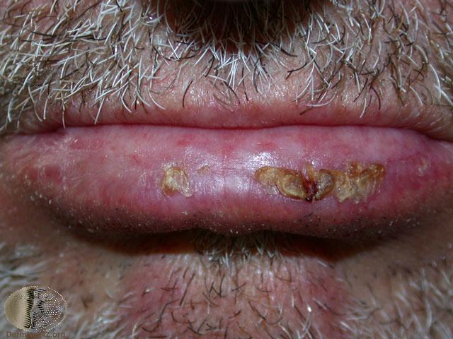 Actinic cheilitis Watch closely for Squamous