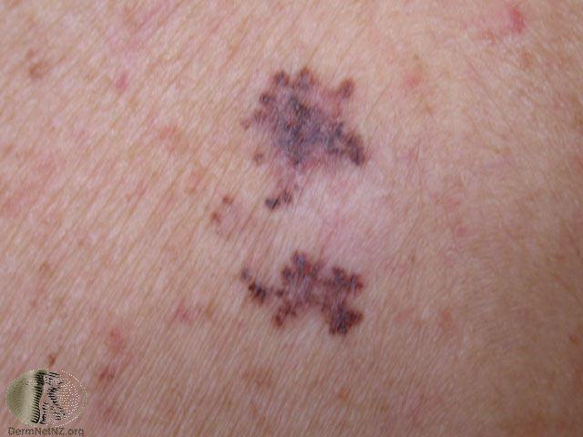 Melanoma with regression again need to LOOK these are often