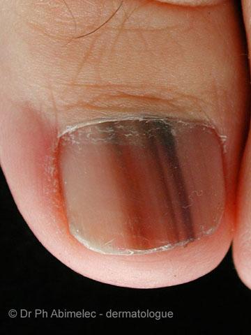 Nail Melanoma VERY DANGEROUS Often detected late can SPREAD