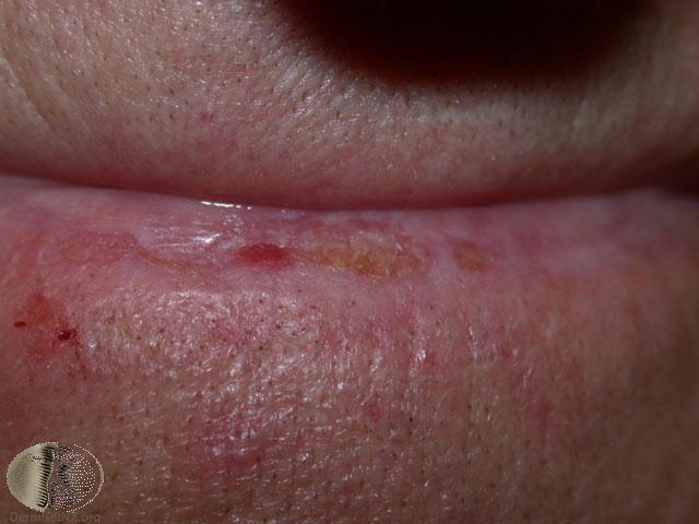 Actinic Cheilitis Lip