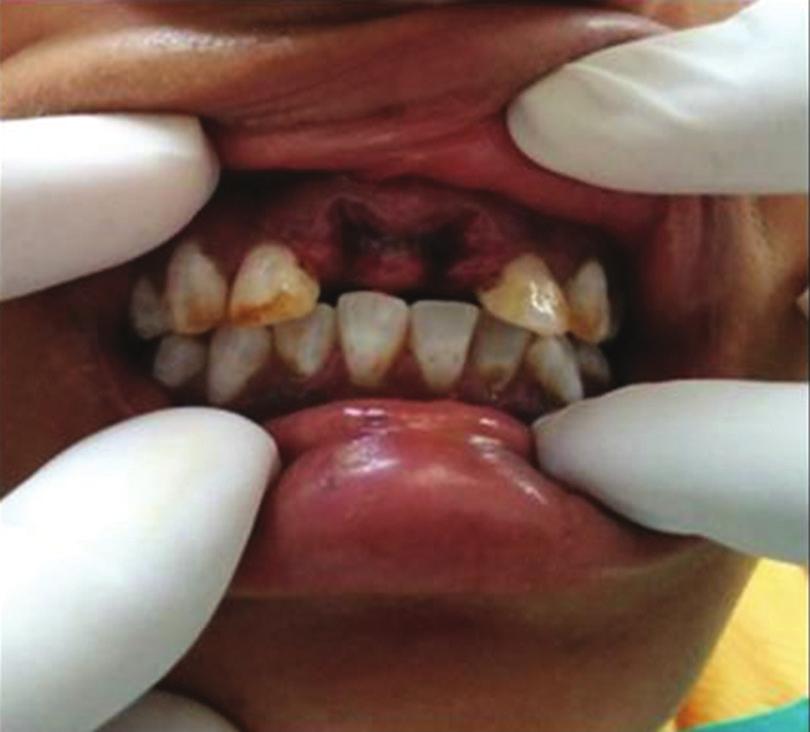 of the most common unfavorable outcomes of replanted cases is the tooth ankylosis.