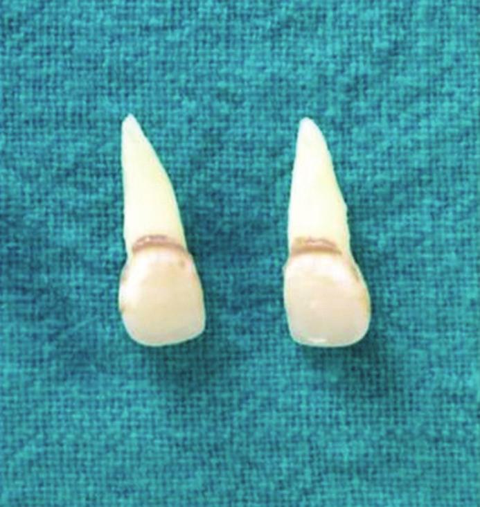 Figure 2: Avulsed teeth. Figure 5: Photograph of replantation after 1-year follow-up. Figure 3: Extraoral obturation done. Figure 6: Radiograph of replantation after 1-year follow-up.