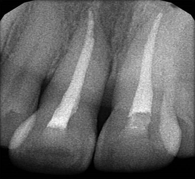 Treatment of such avulsion cases imposes a diagnostic challenge for the clinician. Only choice of treatment left for immediate restoration is the replantation of the avulsed tooth.