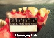 The following three photographs show the eruption of the central (I 1) permanent incisors; the deciduous incisors have been lost.