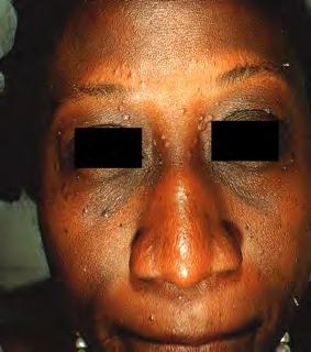 Trichoepithelioma/ Trichoblastoma Solitary: sporadic in childhood or adolescence, flesh-colored, 2-8 mm papule or