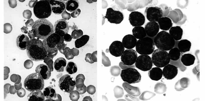 ALL Blast Cells Panel A Panel Figure 2. I Panel A shows a photograph of developing cells in healthy marrow. The variation in the appearance of the cells is characteristic of normal marrow.