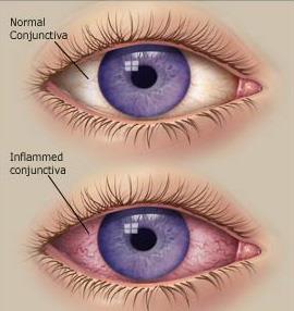 Disorders of the eye Conjunctivitis (Pink eye) Inflammation of the conjunctival membranes in front of the eye/ very