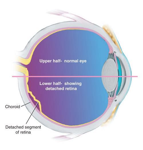 Detached retina Causes: shrinkage or contraction of the vitreous humor,