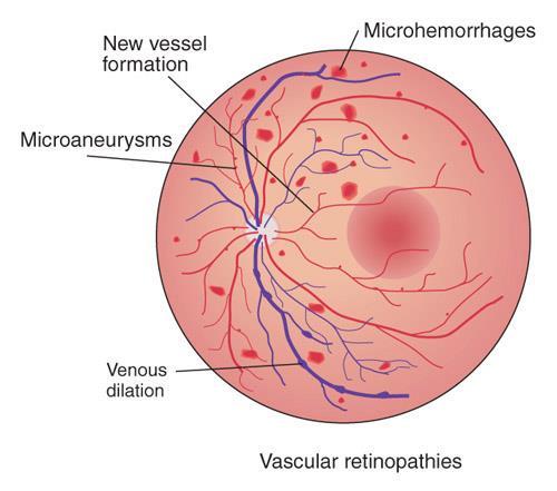 Disorders of the eye Diabetic retinopathy - a complication of diabetes that