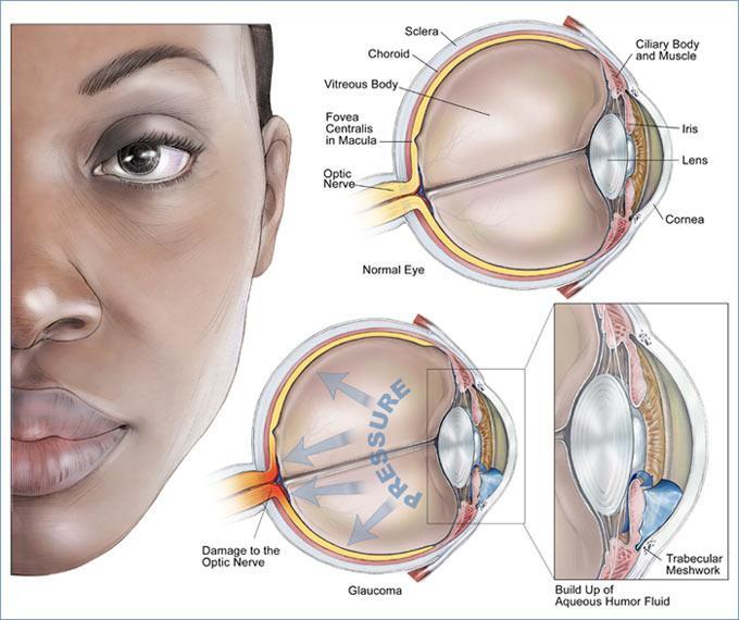 Disorders of the eye Glaucoma excessive intraocular pressure causing destruction of