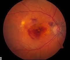 There are 2 types: Dry causes gradual thinning of the retina Wet