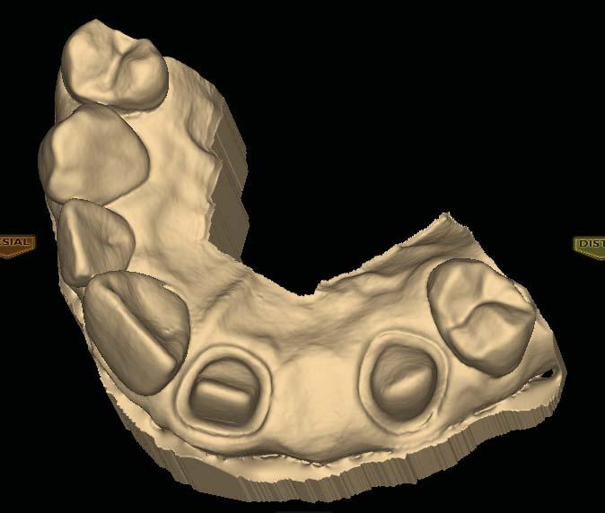 Scan the prepped teeth, the edentulous area, and two or more unprepped neighbors to aid in design and alignment.
