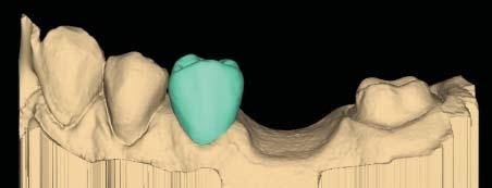 Designing the Bridge With any multiples case, it is generally best to start the Autogenesis process on a tooth with an existing neighbor. In a bridge case, that means starting with the abutments. 1.
