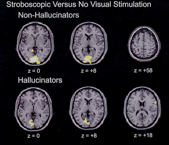 Cortical Activation Patterns NH: Stroboscopic: NH: