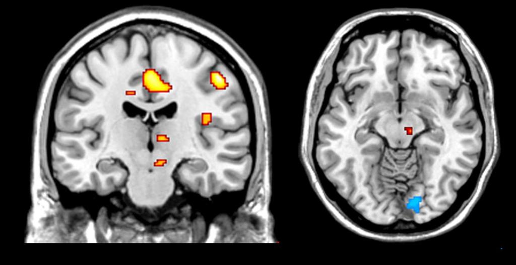 fmri during hallucinations 66 year old man: PD 4 yrs Levodopa for 4 years Ropinirole added Vivid