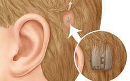Hearing aids Bone conduction Hearing device Hearing Aids Always try