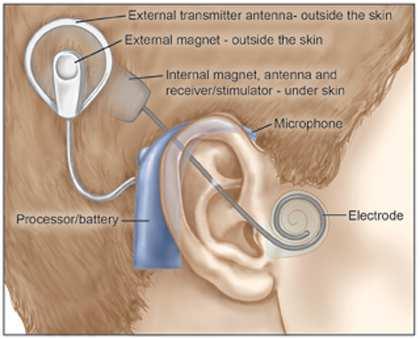 frequency range Non-invasive (make use of the natural hearing mechanisms)