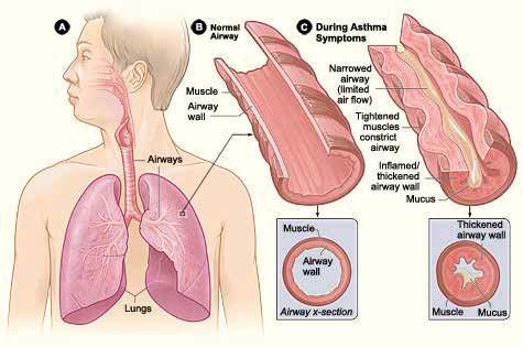 General Information on Asthma for School Staff Asthma is the most common chronic illness among children. Asthma is one of the leading causes of school absence due to illness.