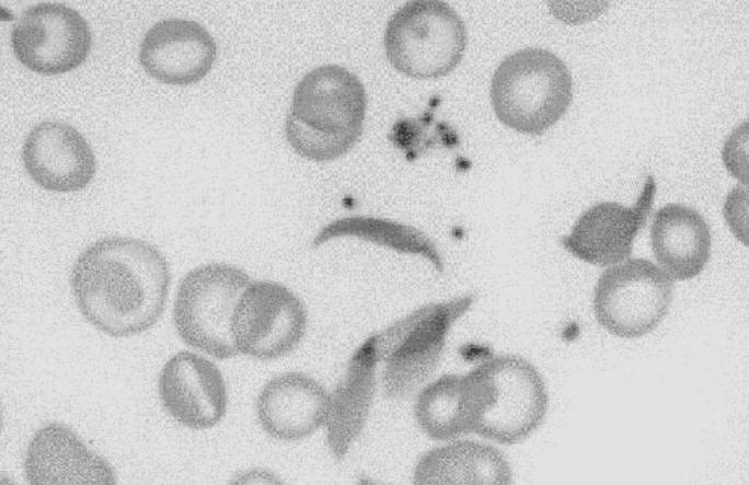 Slika 8. Izgled eritrocita kod anemije srpastih stanica Figure 8 Erythrocytes in sickel cell anaemia zju, Centralnoj Aziji, indijskom podkontinentu i Dalekom istoku i u afričkoj populaciji.
