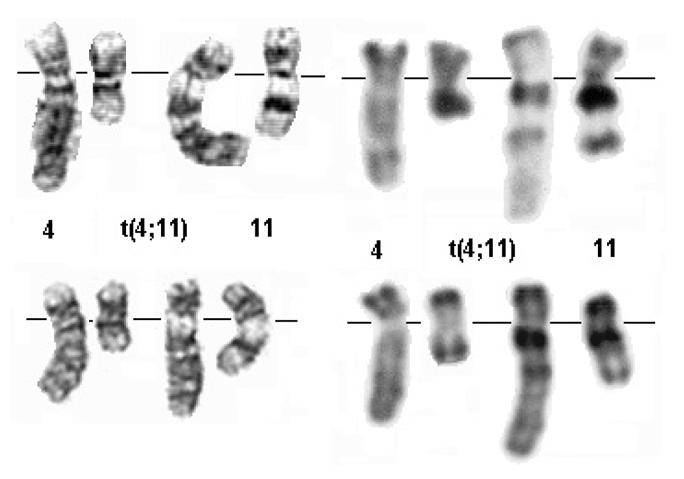 Slika 10. Translokacija 4;11 (q21;q23) Figure 10 Translocation 4;11 (q21;q23) fektni gen od oba roditelja (majka onda mora biti nosilac) ili zbog autosomne translokacije.