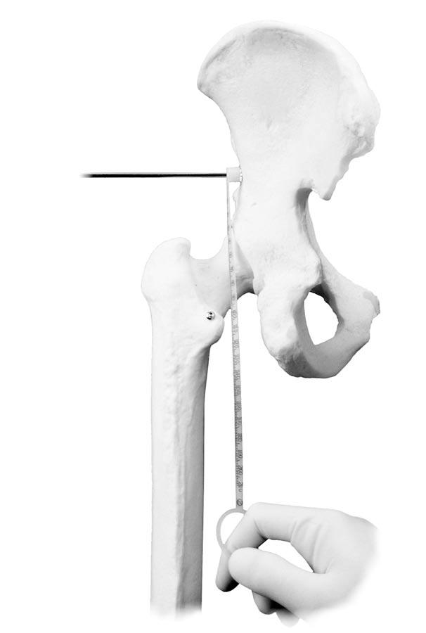 4 VerSys Heritage Primary Hip Prosthesis Determination of Leg Length Establish landmarks and obtain measurements before dislocation of the hip so that a comparison of leg length and femoral offset