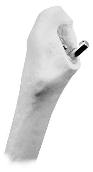 If the natural femoral neck is significantly anteverted, the posterior aspect of the rasp may actually contact the posterior cortex.