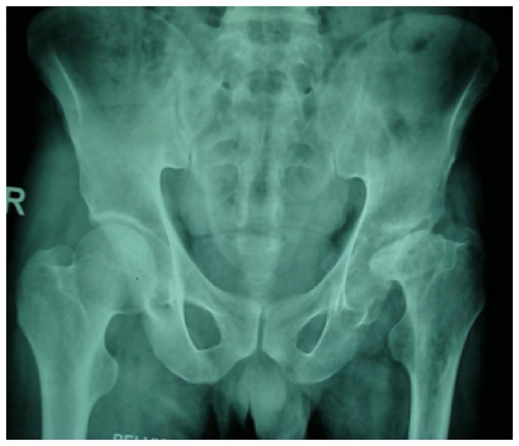 Many series have shown that the rate of loosening and revision of total hip arthroplasty is high in younger patients. The cemented acetabular component has been the source of most of these failures.