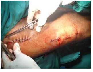 MODE OF INJURY Domestic fall, road traffic accident and fall at work were thee modes of injury among the patients.
