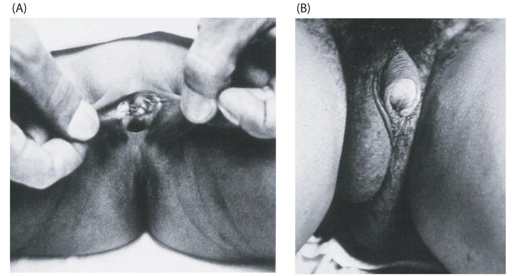 6 Congenital Adrenal Hyperplasia CAH 1/16,000 ambiguous genitalia (fused labia, large clitoris) early pubic hair precocious puberty or failure of puberty to occur (sexual infantilism: absent or