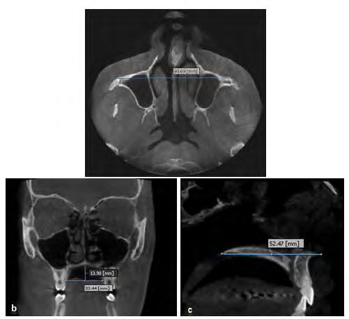 Etemadi, Seylavi and Yadegari FIGURE 1. (a) Distance between the two zygomatic buttresses. (b) Measurement of the width and height of the palate at the maxillary first molar site.
