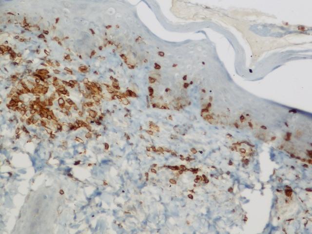 Admixed atypical cells shows irregular