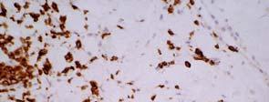 lymphoid cells in the dermis B.