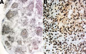 Angioimmunoblastic T-cells