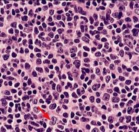cells (indolent B-NHL, aggressive HSTCL) Tumor