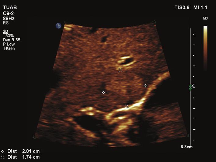 Figure 1 Isoechoic mass of 20x17 mm in segment IV of the liver.