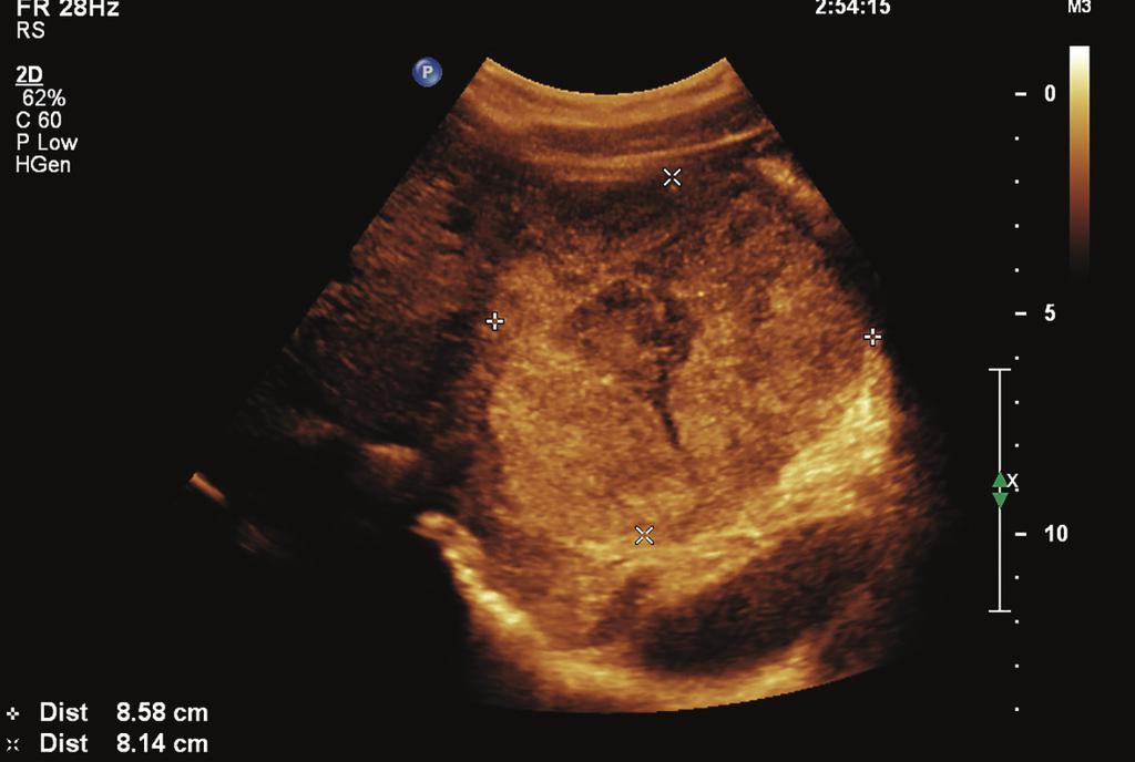B-mode ultrasound did not reveal the nature of the mass. CEUS was used to investigate and further characterize the mass.