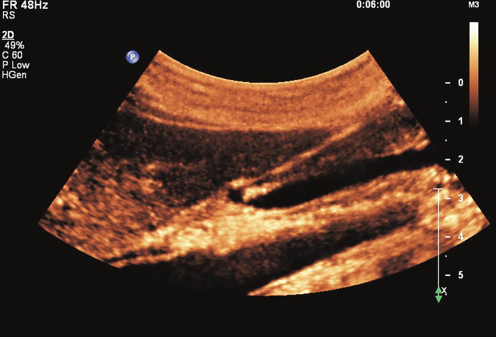 Figure 6 Longitudinal view with normal left liver lobe.